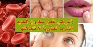 أعراض نقص مخزون الحديد: إشارات تحذيرية لا تتجاهلها