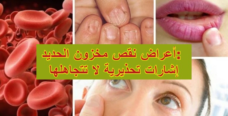 أعراض نقص مخزون الحديد: إشارات تحذيرية لا تتجاهلها