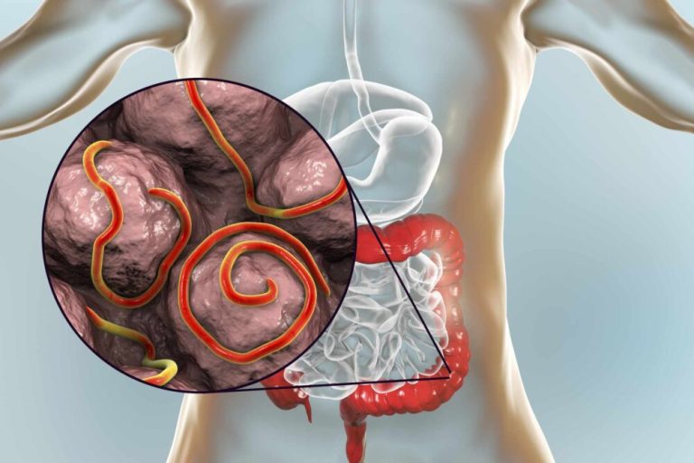 أعراض التسمم الغذائي وكيفية العلاج