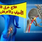 عرق النسا الاسباب و الاعراض و العلاج