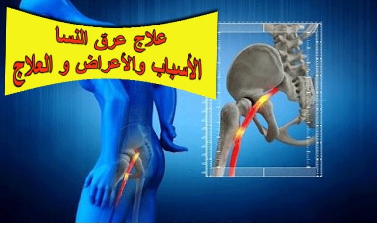 عرق النسا الاسباب و الاعراض و العلاج