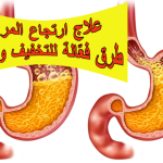 علاج ارتجاع المريء: طرق فعّالة للتخفيف والوقاية