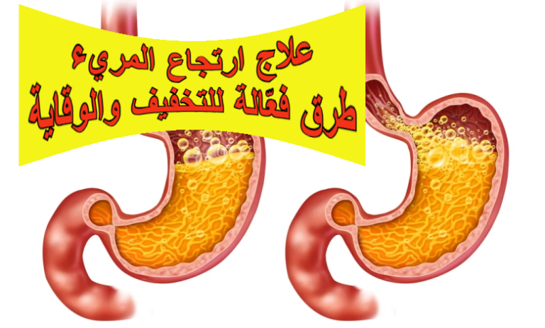 علاج ارتجاع المريء: طرق فعّالة للتخفيف والوقاية