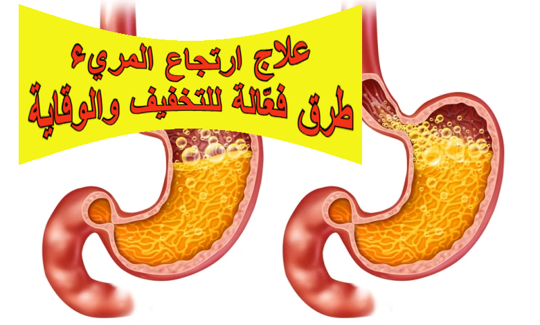 علاج ارتجاع المريء: طرق فعّالة للتخفيف والوقاية