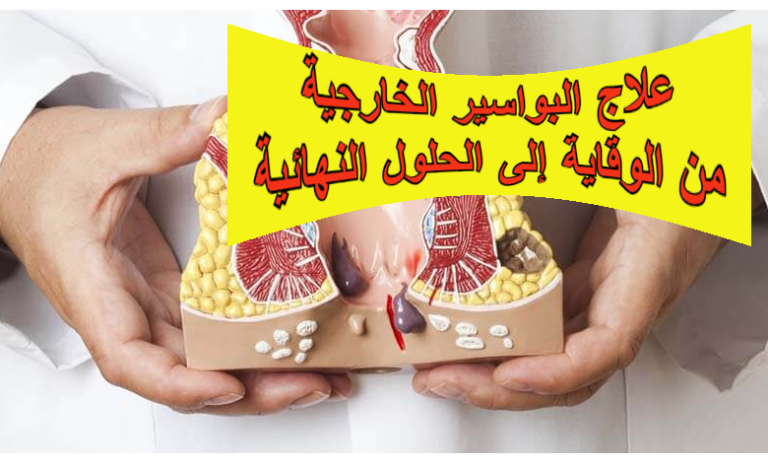 علاج البواسير الخارجية: من الوقاية إلى الحلول النهائية