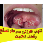 التهاب اللوزتين: تعرف على الأعراض، الأسباب، الفرق عن التهاب الحلق، أفضل علاج منزلي وطبي، وكيفية الوقاية لتجنب المضاعفات.