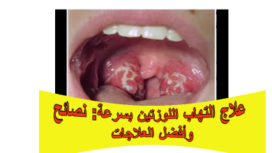 التهاب اللوزتين: تعرف على الأعراض، الأسباب، الفرق عن التهاب الحلق، أفضل علاج منزلي وطبي، وكيفية الوقاية لتجنب المضاعفات.