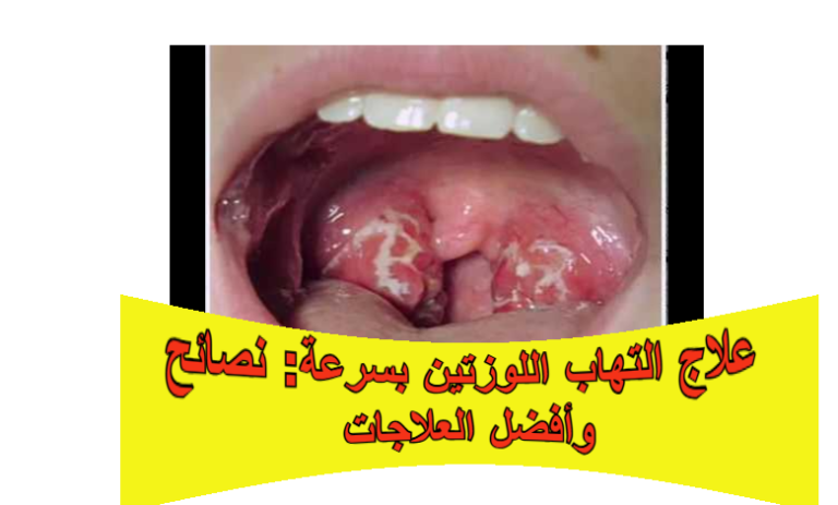 التهاب اللوزتين: تعرف على الأعراض، الأسباب، الفرق عن التهاب الحلق، أفضل علاج منزلي وطبي، وكيفية الوقاية لتجنب المضاعفات.