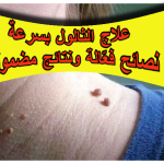 علاج الثالول بسرعة : نصائح فعّالة ونتائج مضمونة