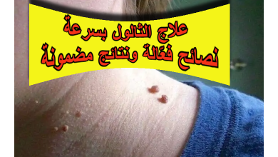 علاج الثالول بسرعة : نصائح فعّالة ونتائج مضمونة