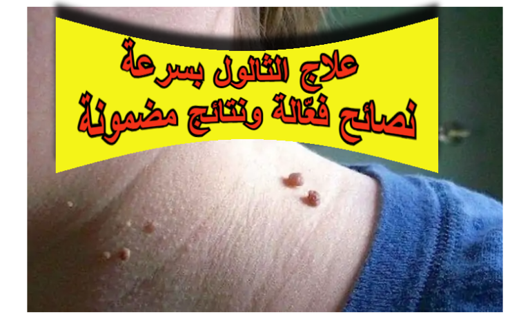 علاج الثالول بسرعة : نصائح فعّالة ونتائج مضمونة