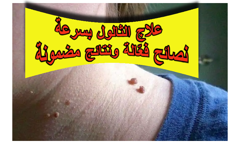 علاج الثالول بسرعة : نصائح فعّالة ونتائج مضمونة