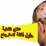 علاج الثعلبة: حلول فعّالة لاسترجاع شعرك