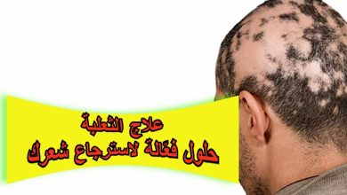 علاج الثعلبة: حلول فعّالة لاسترجاع شعرك