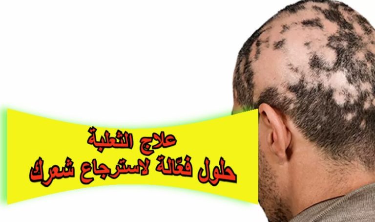 علاج الثعلبة: حلول فعّالة لاسترجاع شعرك