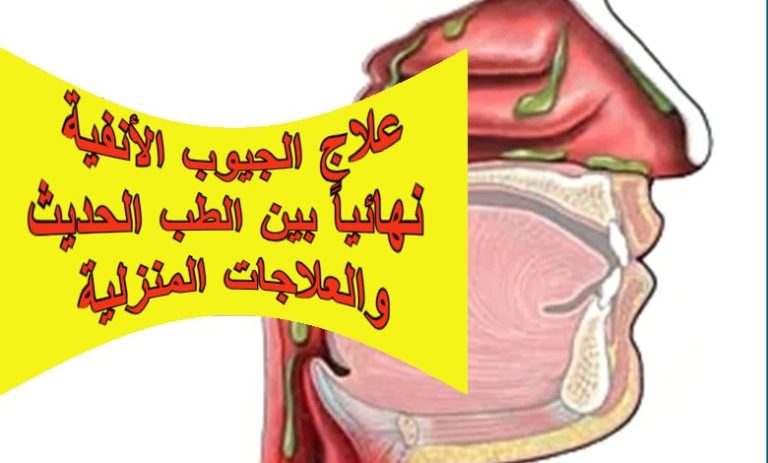علاج الجيوب الأنفية نهائياً بين الطب الحديث والعلاجات المنزلية