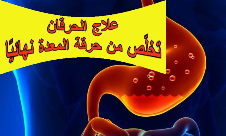علاج الحرقان: تخلّص من حرقة المعدة نهائيًا