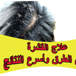 علاج القشرة بأسهل الطرق وأسرع النتائج