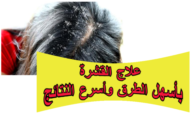 علاج القشرة بأسهل الطرق وأسرع النتائج