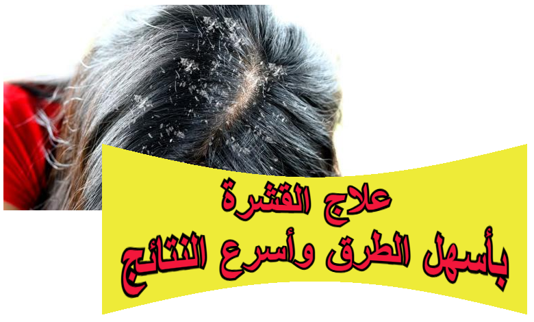 علاج القشرة بأسهل الطرق وأسرع النتائج