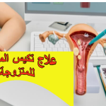 علاج تكيس المبايض للمتزوجة: حلول طبية وطبيعية لتعزيز فرص الحمل