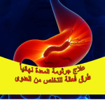 علاج جرثومة المعدة نهائيا