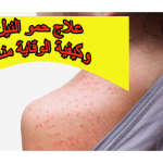 علاج حمو النيل وكيفية الوقاية منه