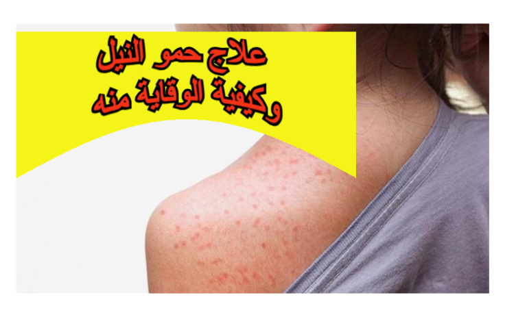علاج حمو النيل وكيفية الوقاية منه