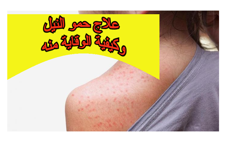 علاج حمو النيل وكيفية الوقاية منه