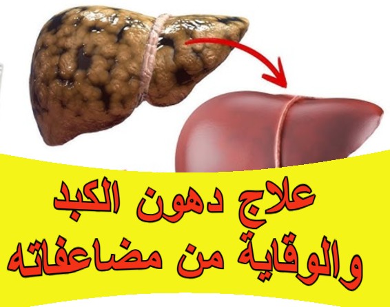 علاج دهون الكبد والوقاية من مضاعفاته