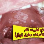 علاج فطريات الفم: الأسباب والأعراض وطرق الوقاية الفعّالة