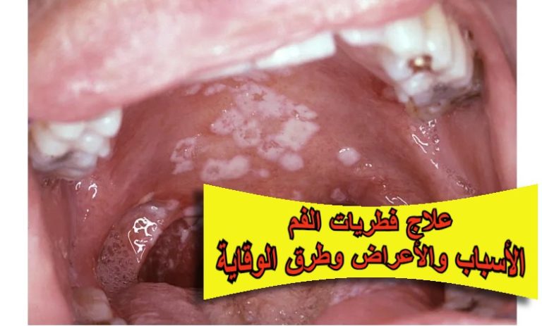 علاج فطريات الفم: الأسباب والأعراض وطرق الوقاية الفعّالة
