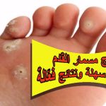 علاج مسمار القدم: خطوات سهلة ونتائج فعّالة