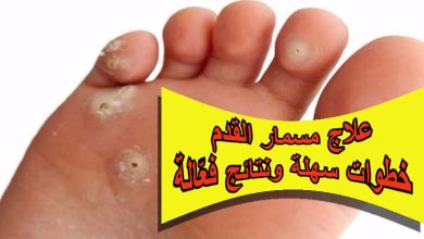 علاج مسمار القدم: خطوات سهلة ونتائج فعّالة