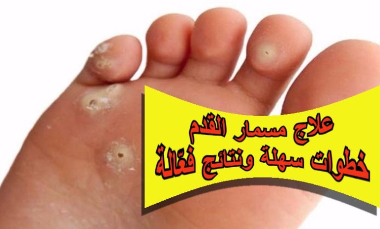 علاج مسمار القدم: خطوات سهلة ونتائج فعّالة