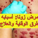 مرض زونا: أسبابه وطرق الوقاية والعلاج