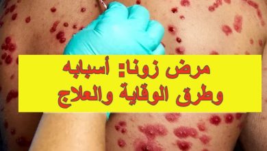مرض زونا: أسبابه وطرق الوقاية والعلاج