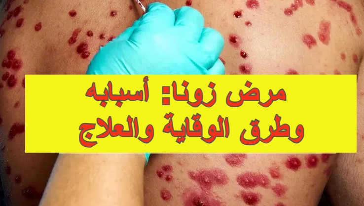 مرض زونا: أسبابه وطرق الوقاية والعلاج