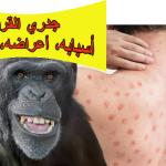 جدري القرود: أسبابه، أعراضه، وعلاجه في المنزل
