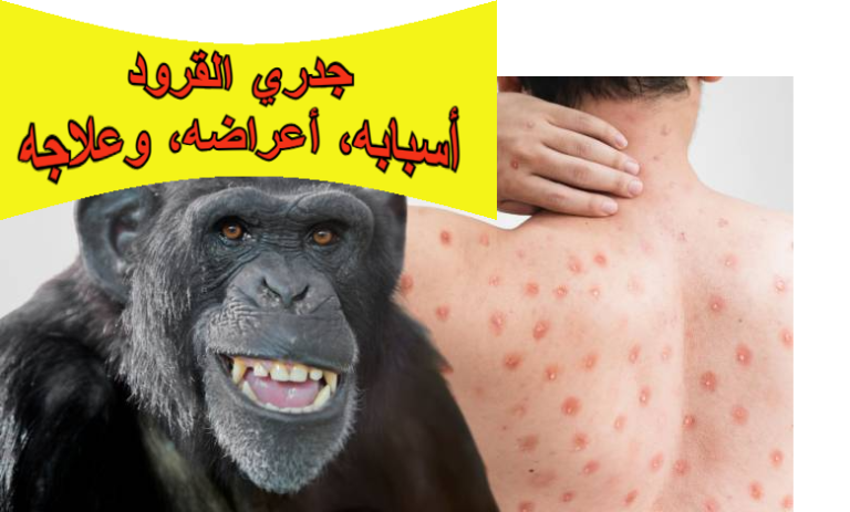 جدري القرود: أسبابه، أعراضه، وعلاجه في المنزل