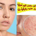 حب الشباب: دليل متكامل لفهم أسبابه وأعراضه وطرق علاجه والوقاية منه