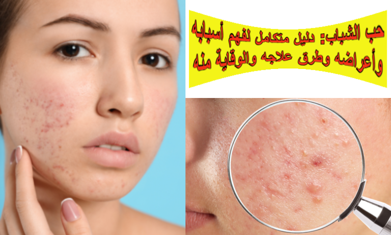 حب الشباب: دليل متكامل لفهم أسبابه وأعراضه وطرق علاجه والوقاية منه