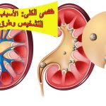 حصى الكلى: الأسباب، الأعراض، التشخيص وطرق العلاج