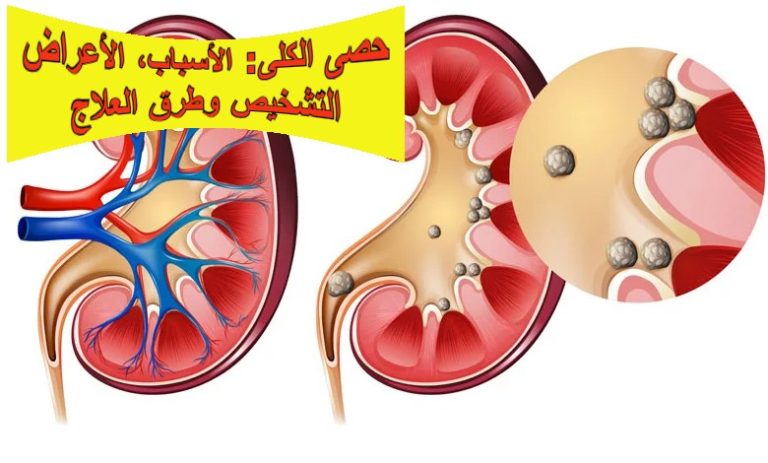 حصى الكلى: الأسباب، الأعراض، التشخيص وطرق العلاج
