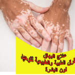 علاج البهاق: أحدث الطرق الطبية والطبيعية لتوحيد لون البشرة