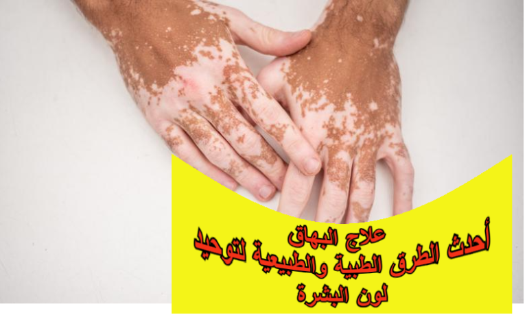 علاج البهاق: أحدث الطرق الطبية والطبيعية لتوحيد لون البشرة
