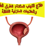 علاج التهاب المثانة: الطرق الطبية والعلاجات المنزلية الفعّالة