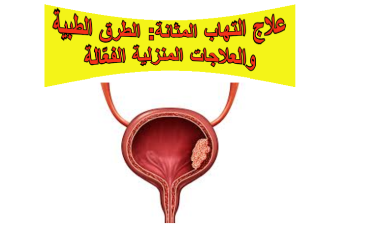 علاج التهاب المثانة: الطرق الطبية والعلاجات المنزلية الفعّالة