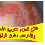 علاج الحزام الناري: الأسباب والأعراض وطرق الوقاية