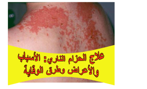 علاج الحزام الناري: الأسباب والأعراض وطرق الوقاية